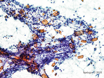 Non-neoplastic. Amylase crystals are non-birefringent crystalline structures with rectangular, needle-shaped, rhomboid, and platelike shapes. They are most commonly associated with non-neoplastic inflammatory conditions as in this case (smear, Papanicolaou stain).